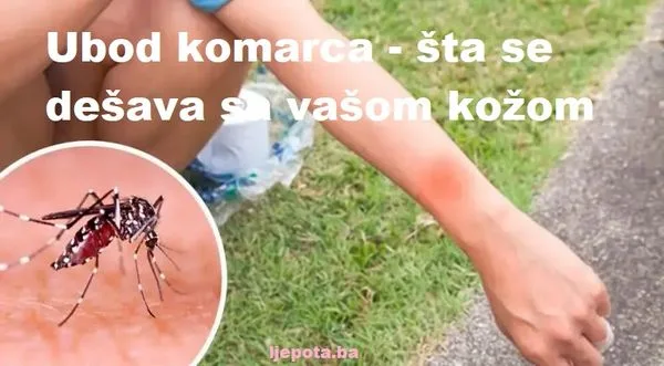 Ubod komarca – šta se događa sa vašom kožom