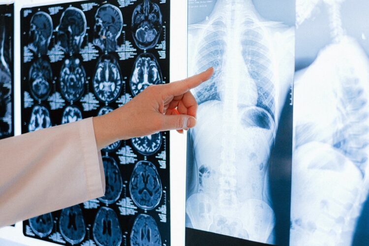 Nova nada za oboljele od hroničnih plućnih bolesti – transplantacija vlastitih plućnih stanica