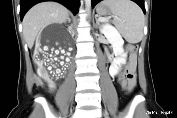 CT snimka bubrežnog kamenca