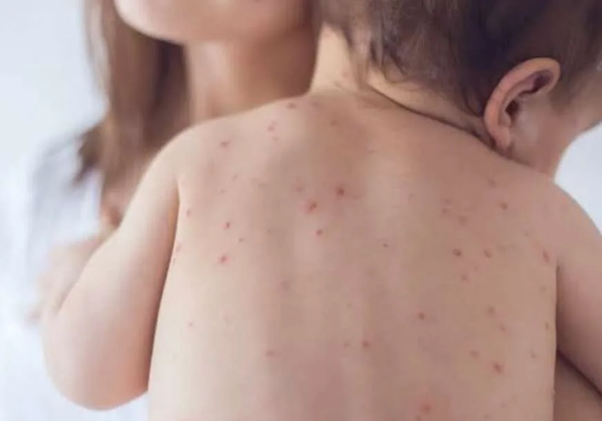 KOJI SU SIMPTOMI I MOGUĆE KOMPLIKACIJE: OVO TREBA DA ZNATE O VARIČELAMA I MORBILAMA