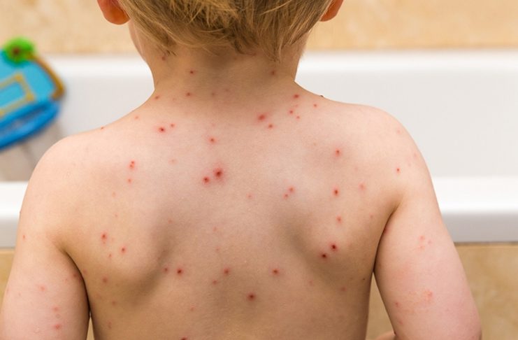 Apel roditeljima u Kantonu Sarajevo: Vakcinišite svoje dijete protiv epidemije morbila!