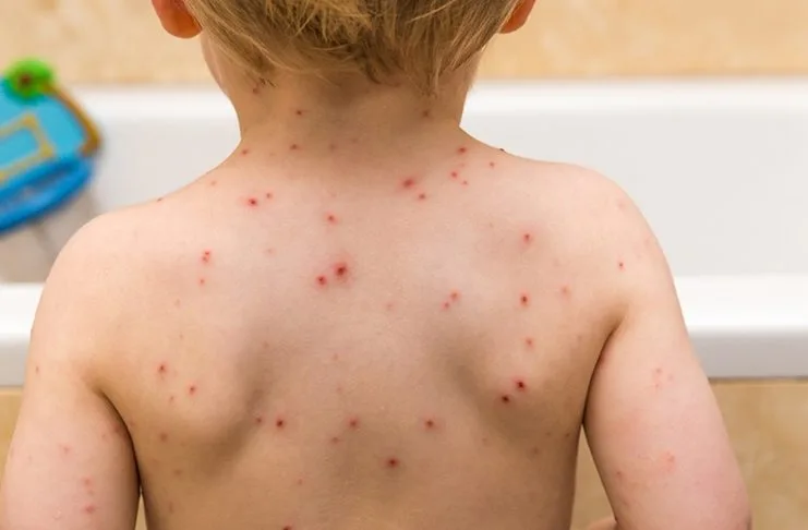 Apel roditeljima u Kantonu Sarajevo: Vakcinišite svoje dijete protiv epidemije morbila!