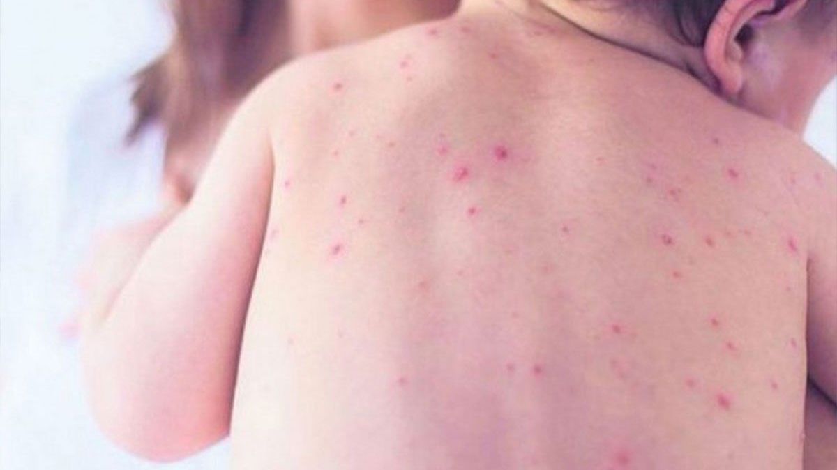 Širi se epidemija morbila i velikog kašlja, mali procenat vakcinisane djece.