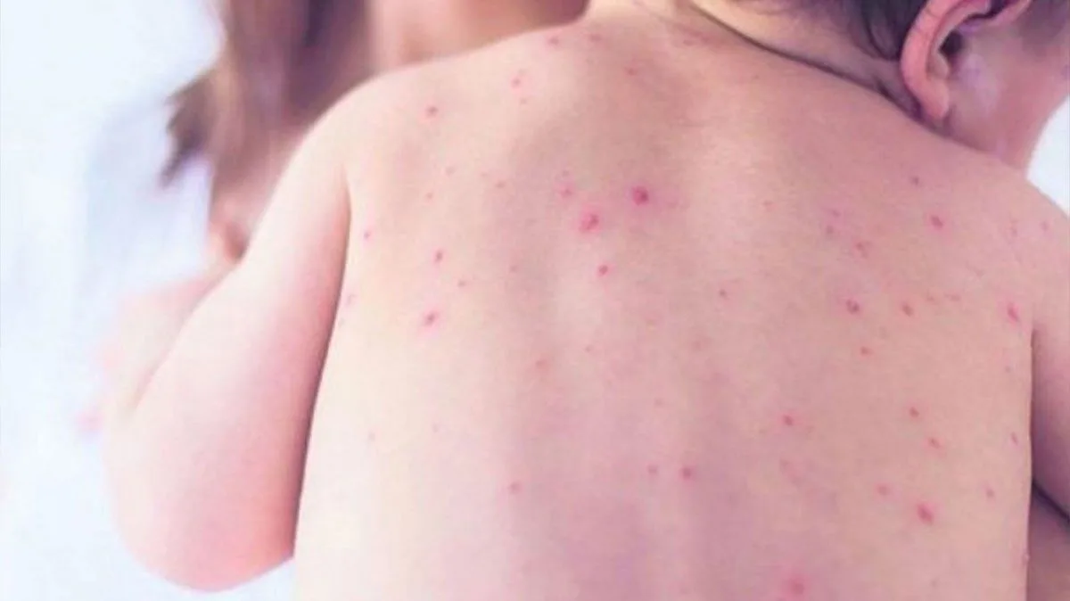 Širi se epidemija morbila i velikog kašlja, mali procenat vakcinisane djece.
