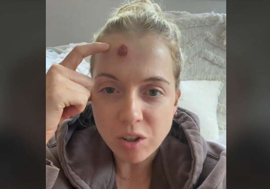 (VIDEO) BIOPSIJA POTVRDILA NAJGORE Mlada majka mislila da joj je izašla bubuljica na čelu, a onda je saznala tešku istinu