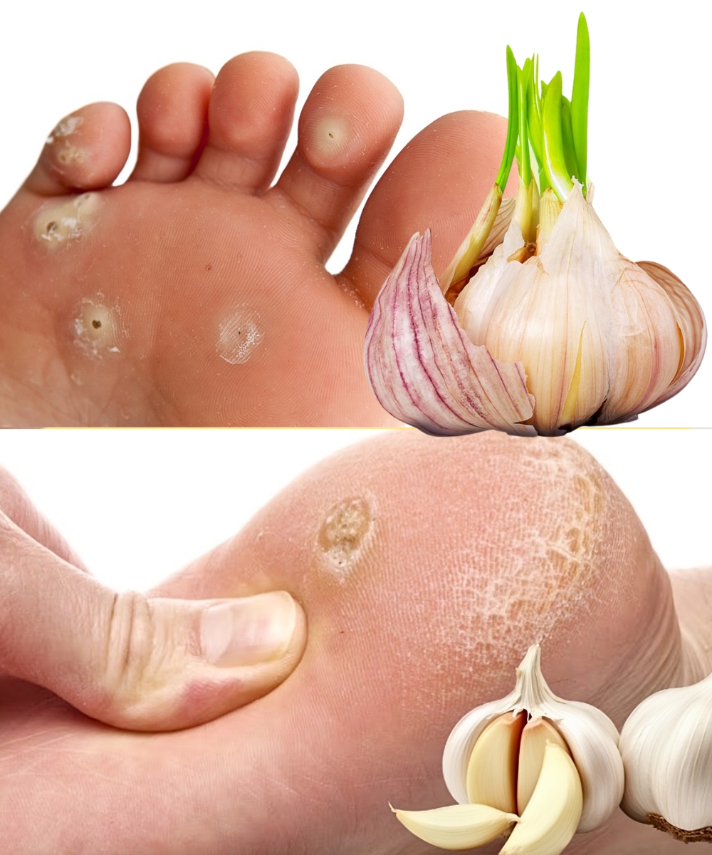 Evo kako sam uklonio kurje oko za samo 3 dana bez odlaska doktoru!