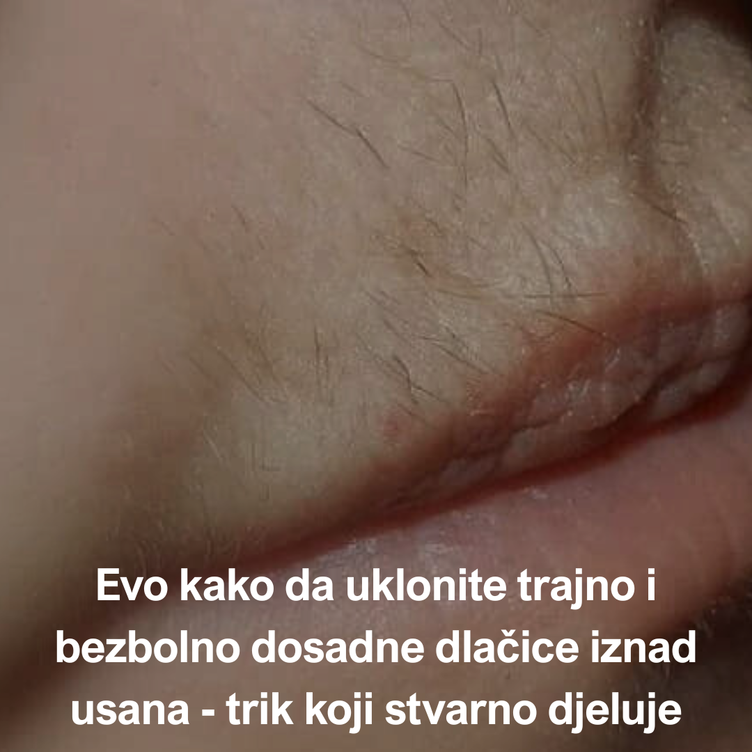 Kako zauvijek riješiti dlačica iznad usana: jednostavan trik koji stvarno djeluje