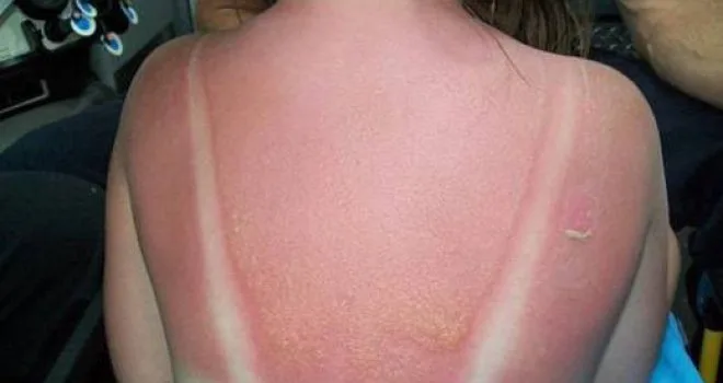Opekotine od sunca nisu šala, evo kako vas mogu dovesti do melanoma: Ne ljuštite površinski sloj kože