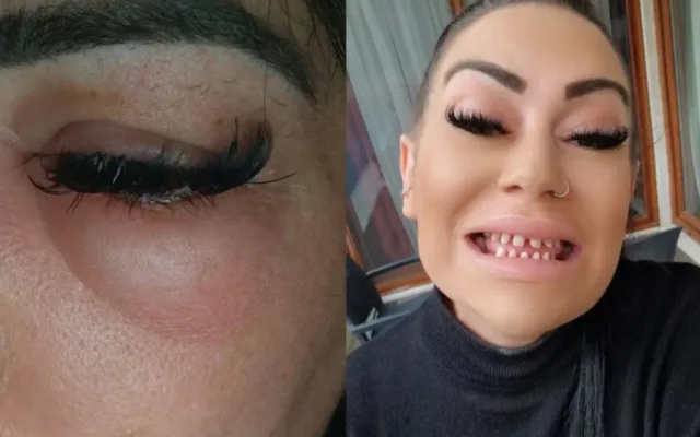 Otišla po nove zube u Tursku a dobila samo probleme: Sada može jesti samo mekanu hranu