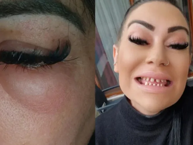 Otišla po nove zube u Tursku a dobila samo probleme: Sada može jesti samo mekanu hranu